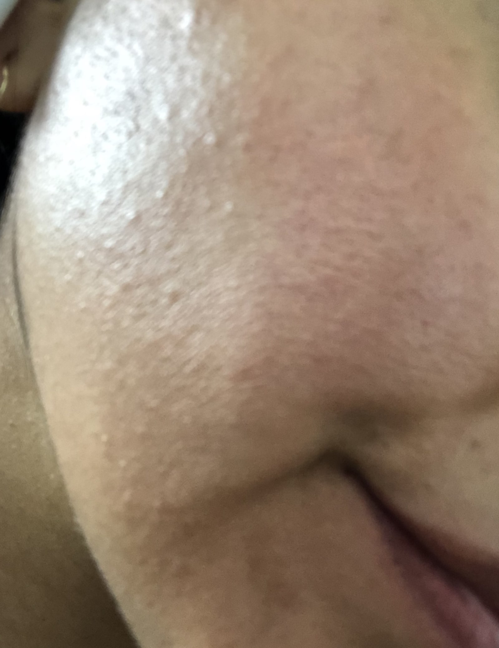 Example of bumpy skin from dehydration
