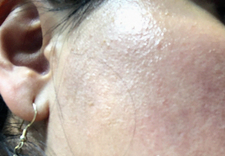 Do You Have Fungal Acne? — Learn How to Treat It Safely! — Leaked Beauty