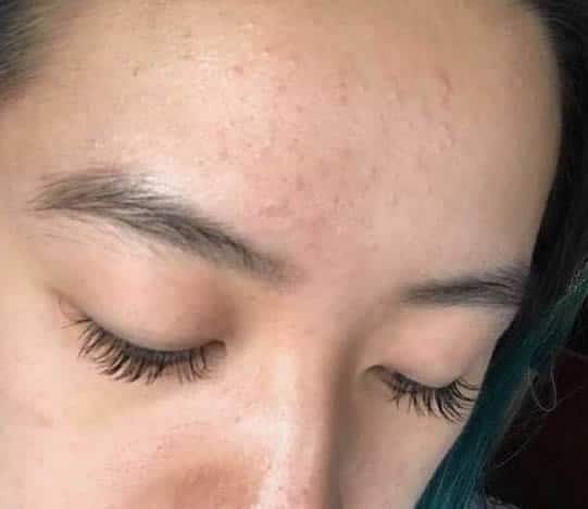 fungal acne on forehead (reddit)